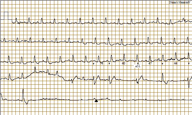 muž 72 let s RBBB opakovaně