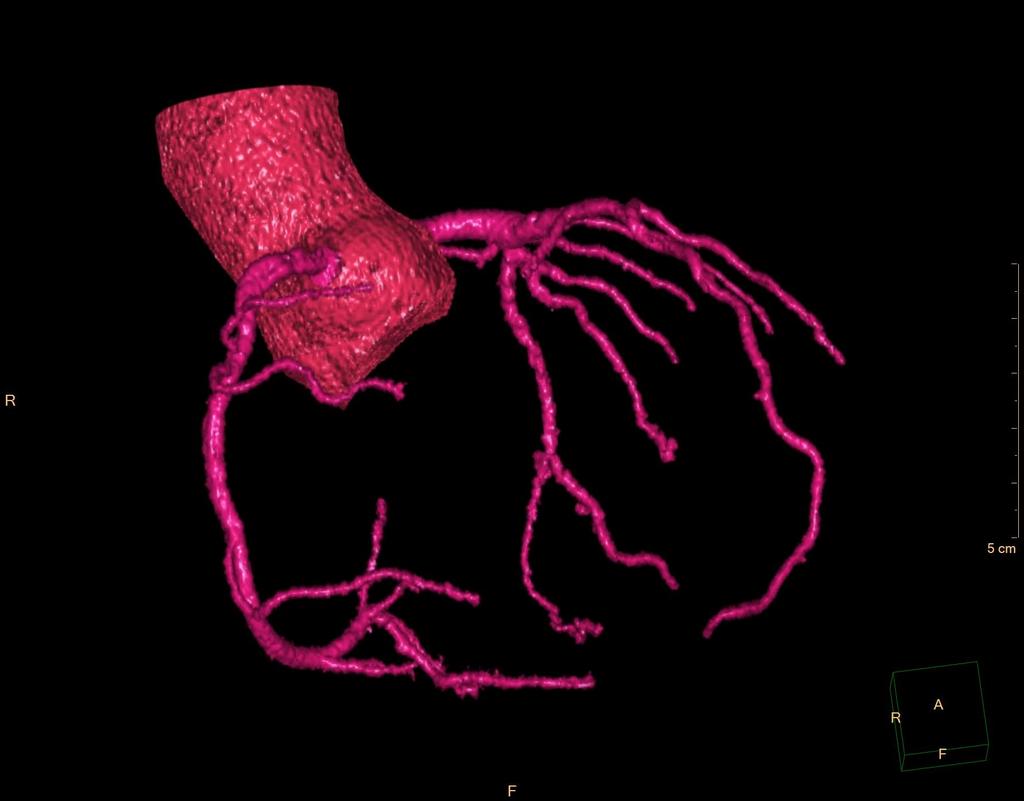 3D CT koronarografie / 3D CT coronarography pohled zprava / right view a. coronaria sin. bulbus aortae rr. diagonales a. coronaria dx. r. marginalis sin.