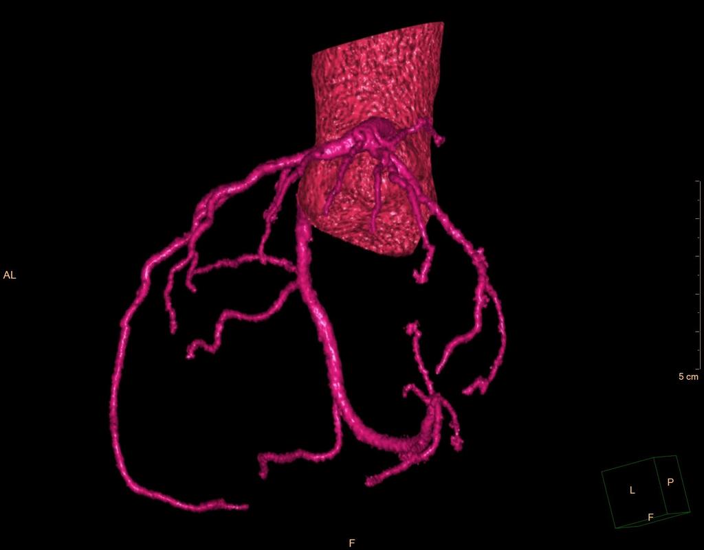 3D CT koronarografie / 3D CT coronarography pohled zleva / left view r. interventricularis posterior rr. diagonales a.