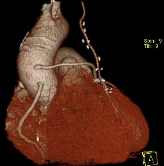 thoracica interna sinistra to RIA ( LIMA-RIA ) (1) Aortokoronární bypass pomocí štěpu z v.