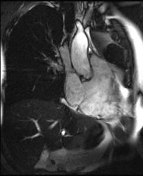 MR srdce: vtoková část pravé komory MRI of the heart: pars/tractus inffluxionalis ventriculi dextri (right ventricular inflow tract) aorta