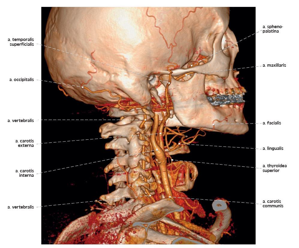 3D rekonstrukce CT angiografie tepen krku a hlavy 3D