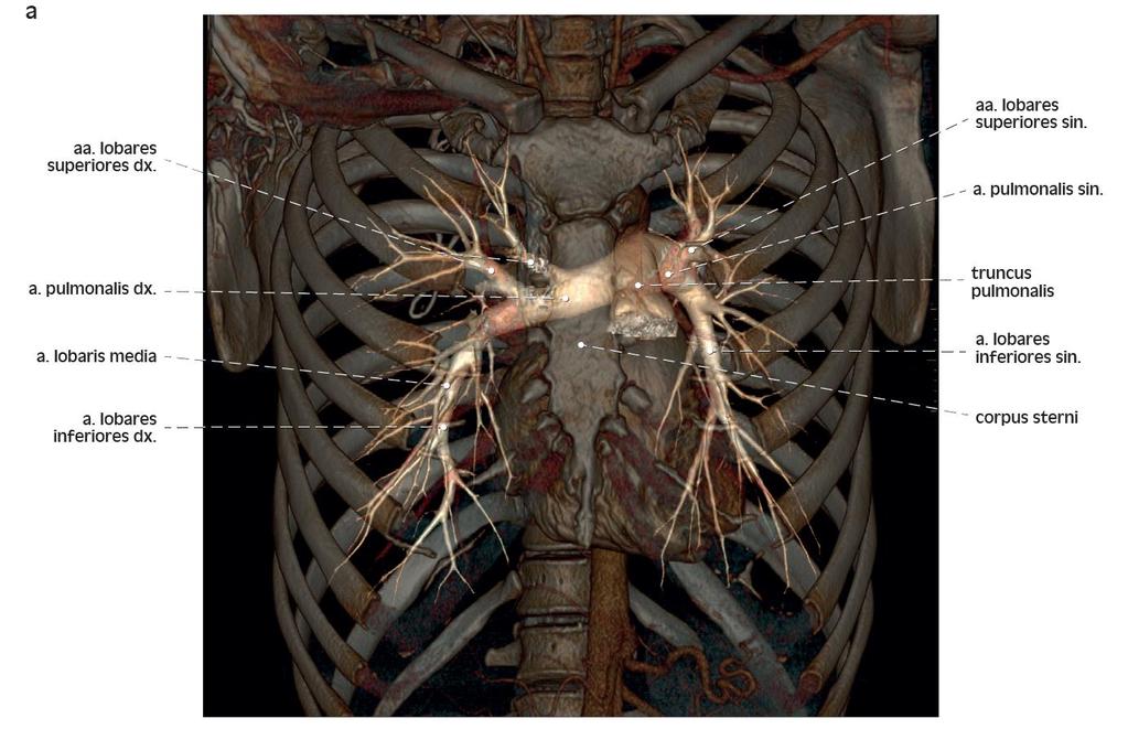 3D rekonstrukce CT angiografie plícnice 3D
