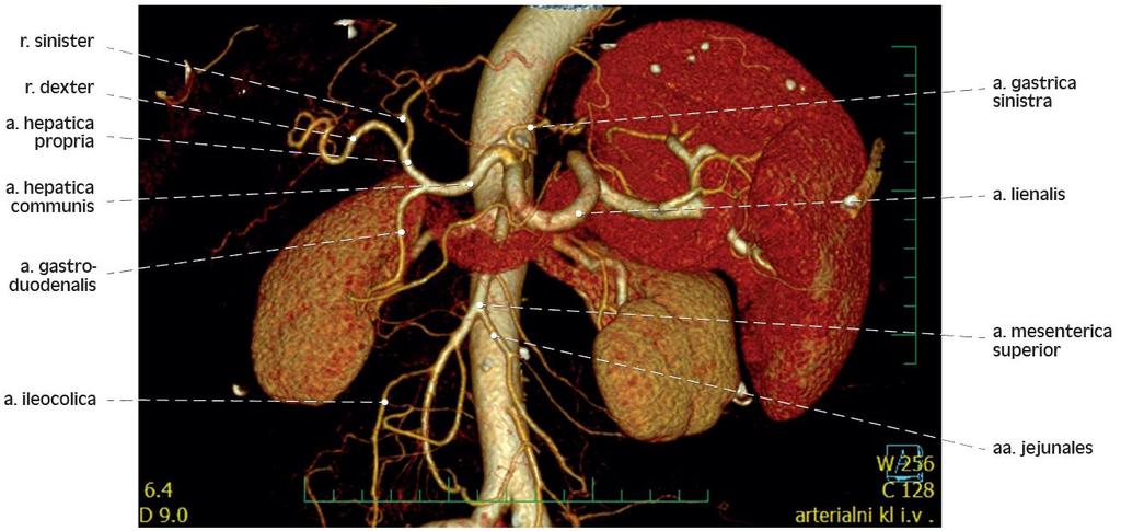 3D rekonstrukce CT angiografie břišní srdečnice 3D