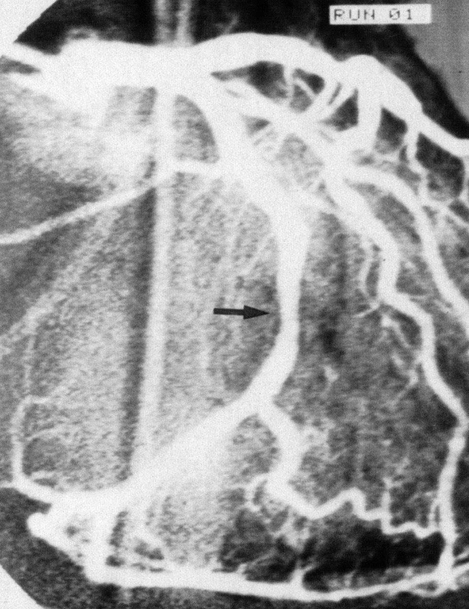 Transluminal Coronary Angioplasty