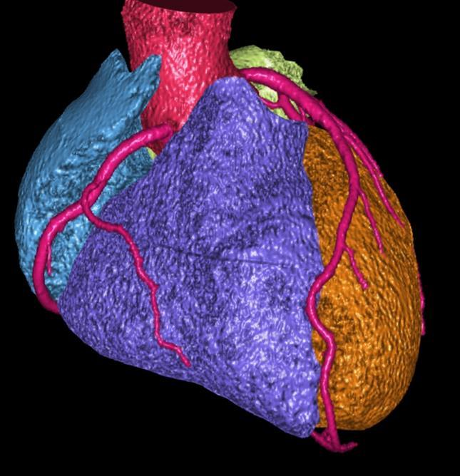 3D CT koronarografie / 3D CT coronarography