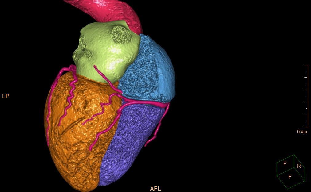 3D CT koronarografie / 3D CT coronarography pohled zdola / inferior view r. marginalis sin. (RMS) atrium sin. atrium dx. r. posterolateralis sin.