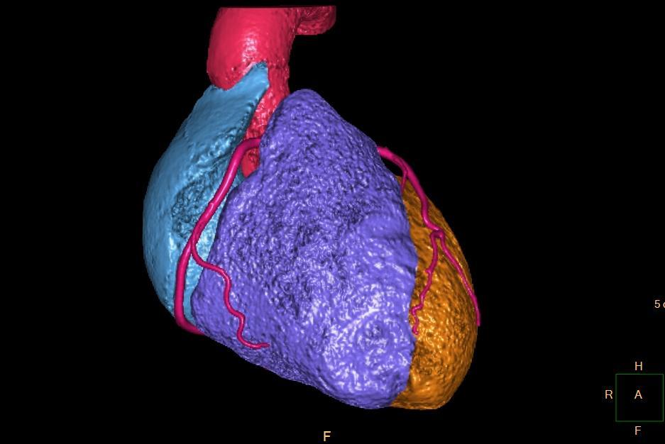 3D CT koronarografie / 3D CT coronarography je to nutné ještě jednou??? A.