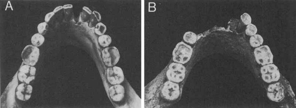 80 Obrázek 15. Míra obrusu dolní čelisti: zemědělec (A), lovec- sběrač (B) (převzato z Smith, 1984).