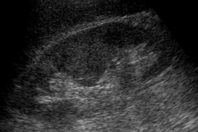 Vrozené vývojové vady (3) Perzistující fetální lobulizace (v 5%) normálně může přetrvávat do věku 4-5 let, vtažení kontury ledviny v místě mezi kalichy Hypertrofická Bertiniho columna