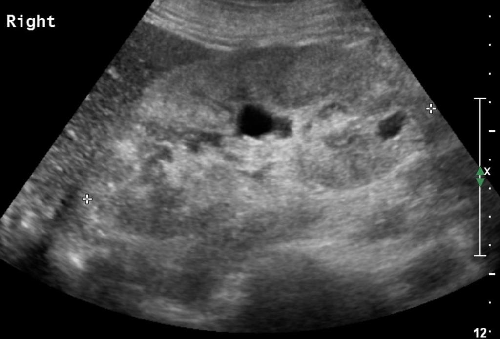 Abnormality parenchymu (2) Klasifikace parenchymových chorob ledvin : typ 1 - zvýšená odrazivost kůry, pyramidy normální glomerulonefritidy, angiitidy,nefroskleróza, amyloidóza,