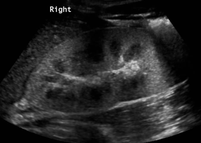 Neinfekční záněty Glomerulonefritidy Akutní postinfekční GN - po streptok.