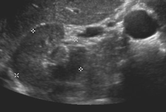 Anatomie Renální sinus cévy, lymf.