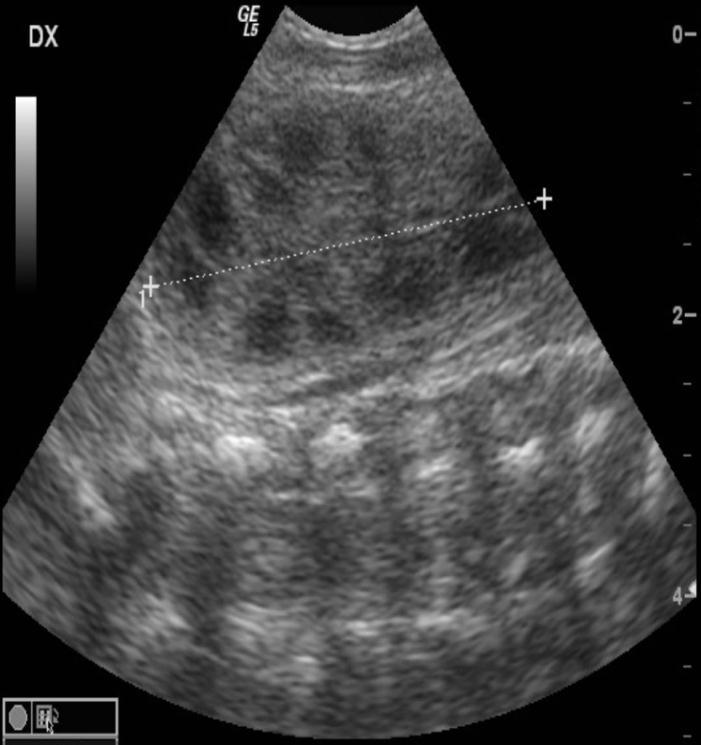 Obr. 1: UZ obraz normální ledviny v longitudinálním zobrazení 3.2 Anatomie ledvin Ledviny jsou párovým orgánem. Mají charakteristický tvar, který se přirovnává fazolovému bobu.