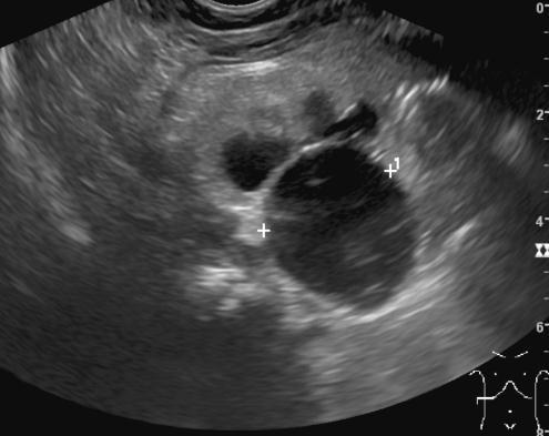 Příčinami dilatace ledvinné pánvičky může být stenóza pyeloureterálního přechodu, komprese pyeloureterálního přechodu nadpočetnou renální cévou, vysoký odstup močovodu z ledvinné pánvičky nebo