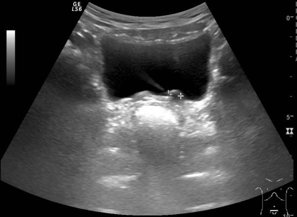 Ureterokéla Ureterokéla je balonovité vyklenutí sliznice ureteru do močového měchýře, na jehož vrcholu je bodovité ústí močovodu.
