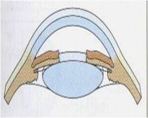 Glaukom 17 změn na terči zrakového nervu a zorného pole.