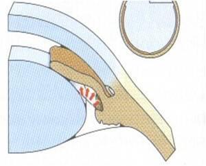 Glaukom 18 Akutní primární glaukom s uzavřeným úhlem (AACG) Projevuje se bolestmi hlavy a oka, občasnou nevolností, nauzeou, zhoršením viděním, vidění může být zamlžené nebo se může pacientovi zdát,