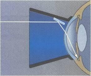 Můžeme použít dva typy gonioskopických čoček: první typ umožňuje světlu vstoupit z oka přímo a druhý typ nepřímo reflektuje paprsky zpět pomocí zrcadla (Obr. 7.).
