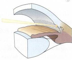 Chirurgická terapie 42 Obr. 22. Laserová trabekuloplastika v komorovém úhlu [4] 5.1.2. Nd-YAG-laserová iridotomie Nd-YAG-laserová iridotomie je fotodisrupční metoda.