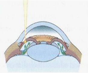 Chirurgická terapie 43 Obr. 23. Laserová iridotomie [4] 5.2. Klasická chirurgie glaukomu Klasická chirurgie glaukomu se volí tehdy, když stále dochází k progresi ztráty zrakových funkcí i přes medikamentózní a laserovou léčbu.