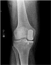 osteotomie je výkon, který zachovává kloub a oddaluje nutnost užití totální endoprotézy až o 5 10let. Hemiartroplastika metodou volby při poškození pouze jedné části kolene.