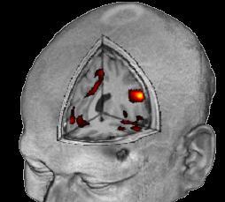 Funkční zobrazování magnetickou rezonancí fmri = functional magnetic resonance imagin, je moderní zobrazovací metoda, pomocí níž se snažíme mapovat funkční oblasti mozku aktivované při provádění