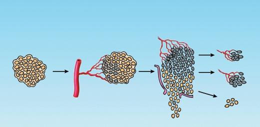 Vznik angiogenního fenotypu v primárním nádoru neovaskularizace expanze nádoru karcinom in situ" vznik angiogenního klonu céva PF-4 (platelet factor 4) je protein uvol- Àovan z α-granulí krevních