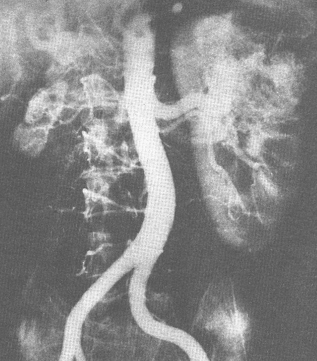 Angiografie při