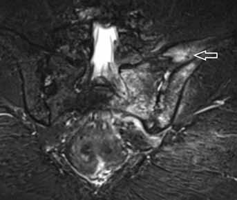 A T2W trojúhelníkovitá skleróza v lopatě kyčelní při SI kloubu; B T2 TIRM není edém, trojúhelníkovitá skleróza Fig. 16. Osteitis condensans ilii.