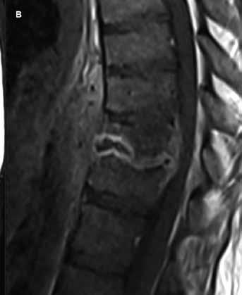 A T1W edema in vertebral bodies and surrounding tissues; B T1W post gadolinium the saturation of the hem of abscess and inflammatory changes in the neighborhood revmatologem a radiologem výrazně