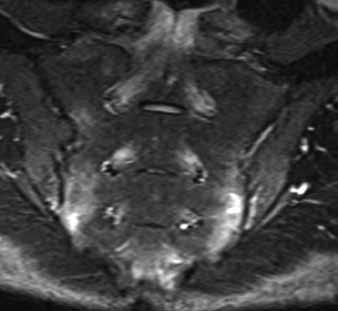 mm či kostní apozice < 2 cm 4 těžké postižení kostní deformity a apozice > 2 cm BASRI páteř (bederní páteř AP a laterální projekce je hodnocena, vybrána ta, kde je vyšší skóre, na C páteři hodnocena