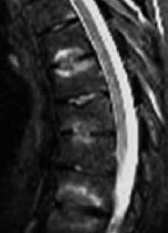 Výpočetní tomografie (CT) Obr. 8 Obr. 8. Spondylodiscitida, edém disků a přilehlých okrajů obratlových těl ve více etážích, T2 FS Fig. 8. Spondylodiscitis involving the disk and both vertebral endplates, T2FS ky, spolu s edémem disku (obr.