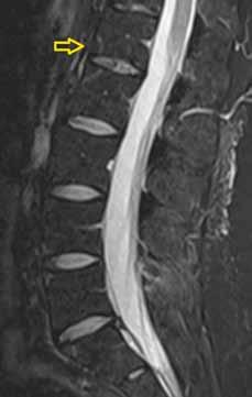 Chronic changes on the spine by AxSpA.