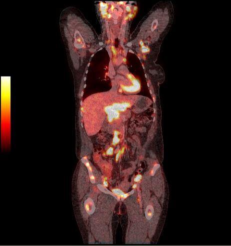 vyšetření PET/CT s 18