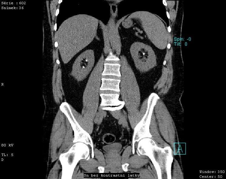 Závěr: V pravé ledvině jsou patrny 3 drobné konkrementy, největší je o velikosti 9 mm, dva drobnější o velikostech 4,5 a 4,5 mm. Všechny konkrementy jsou smíšené cystino-hydroxyapatitové.