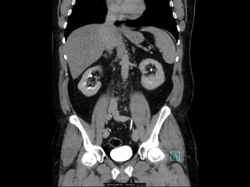 Obrázek 3: CT vylučovací fáze - koronární řez Zdroj: FN Plzeň SPIRÁLNÍ CT UROTRAKTU NATIVNĚ 4. 6. 2015 Závěr: Ledviny jsou bez městnání, nativně bez ložisek.