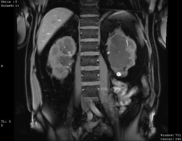 Vyšetření provedeno na 3T přístroji nativně v T1 VIBE, T1 FLASH 2D, T2 truefisp, T2 HASTE, DWI a po aplikaci kontrastní látky i. v. dynamicky v T1 VIBE TWIST a T1 VIBE FS.