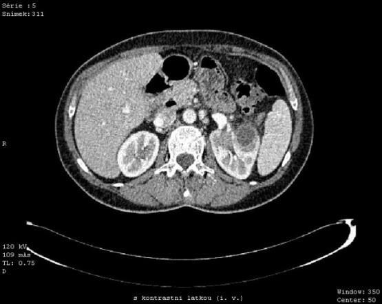 Obrázek 8: CT venózní fáze - axiální řez Zdroj: FN Plzeň MR LEDVIN 10. 2.