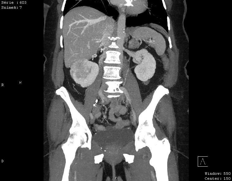 USG 16. 6. 2015 Závěr: Náhodně nalezen tumor pravé ledviny o velikosti 56 mm. CT VYŠETŘENÍ 19. 6. 2015 Indikace: Tumor pravé ledviny Vyšetření provedeno s k.