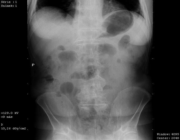 RTG BŘICHA 11. 1. 2015 Závěr: Přiměřená střevní pneumatizace a formátovaný obsah tračníku, bez distenze či hladin. Obrázek 22: RTG břicha Zdroj: FN Plzeň USG LEDVIN 14. 1. 2015 Pravá ledvina o délce 105 mm, bez městnání.
