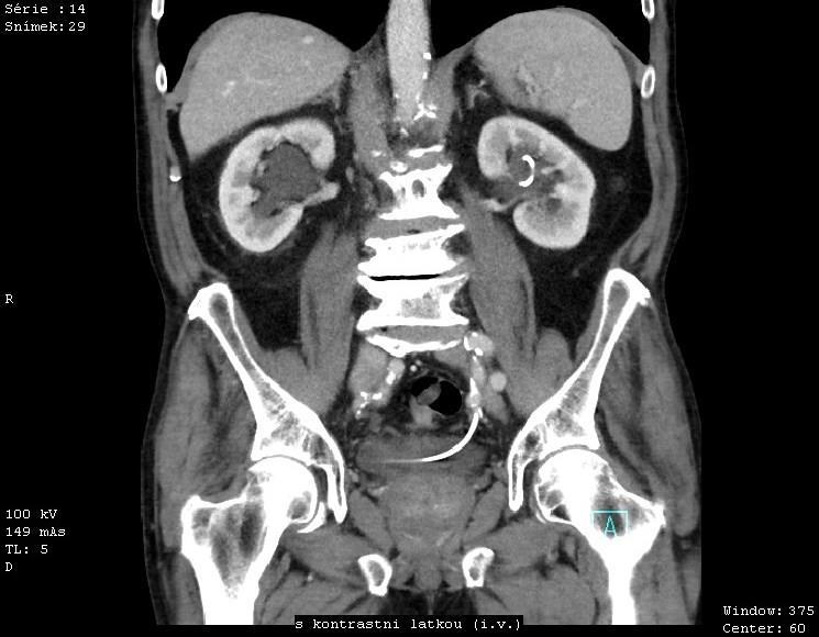 Obrázek 24: CT - Hydronefróza vpravo Zdroj: FN Plzeň USG LEDVIN 6. 3. 2015 Indikace: Dilatace vlevo. Dilatace dutých systémů obou ledvin. Vlevo AP rozměr pánvičky je do 14 mm. Vpravo kolem 24 mm.
