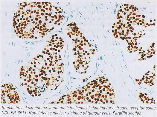 HISTOLOGIE Počet mitóz Proliferační faktor (Ki67) Stupeň diferenciace (Grade) Nekrózy Jaderná