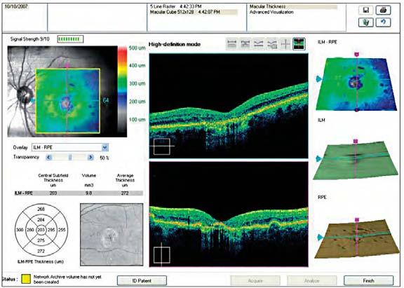 3.3 Kvantitativní analýza Vedle kvalitativního vyhodnocování tomografických zobrazení patří k důležitým funkcím OCT technologie také analýza kvantitativní.