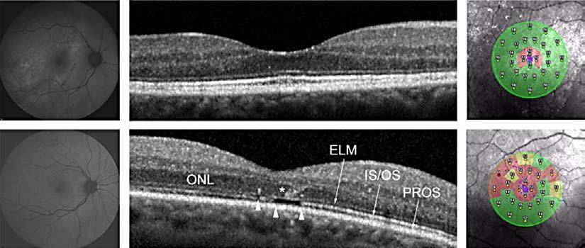 Obr. 3-9 Ukázka kombinace zobrazovacích metod Kombinace zobrazovacích metod: autofluorescenční fundus, sken spektrálního OCT a OCT/SLO mikroperimetrie u pacienta po úspěšné operaci odchlípení sítnice.