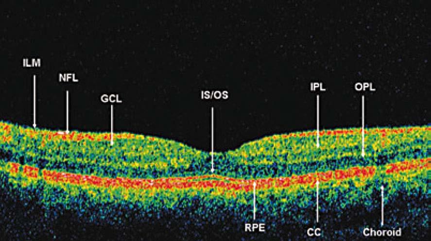 4 Zdravá sítnice a OCT Před tím, než přistoupíme k popisu klinické aplikace OCT, je důležité, abychom porozumněli tomu, jak anatomii zdravé sítnice OCT zobrazuje.