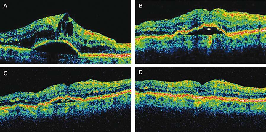 Obr. 5-4 OCT skeny před a po intravitreální léčbě exudativní VPMD Avastinem A: Počíteční stav s vizem 6/120 B: Vizus po jednom týdnu 6/36 C: Vizus po jednom měsíci 6/18 D: Vizus po dvou měsících 6/12