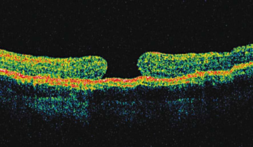 Na příkladu, který je na Obr. 5-5D, lze vidět plně utvořenou makulární díru s několika retinálními cystami v blízkosti okraje díry.