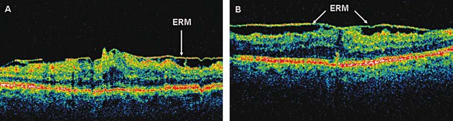 Formování epiretinální membrány je na skenu OCT charakterizováno zelenou linkou s načervenalými odstíny probíhajícími přes povrch sítnice.