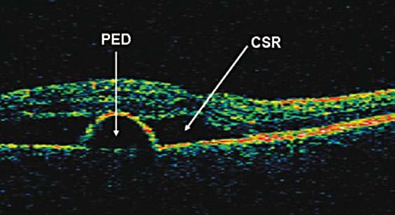 Obr. 5-17 Centrální serózní retinopatie s odchlípením pigmentového epitelu Centrální serózní retinopatie (CSR) může být spojována rovněž s odchlípením pigmentového epitelu (PED).